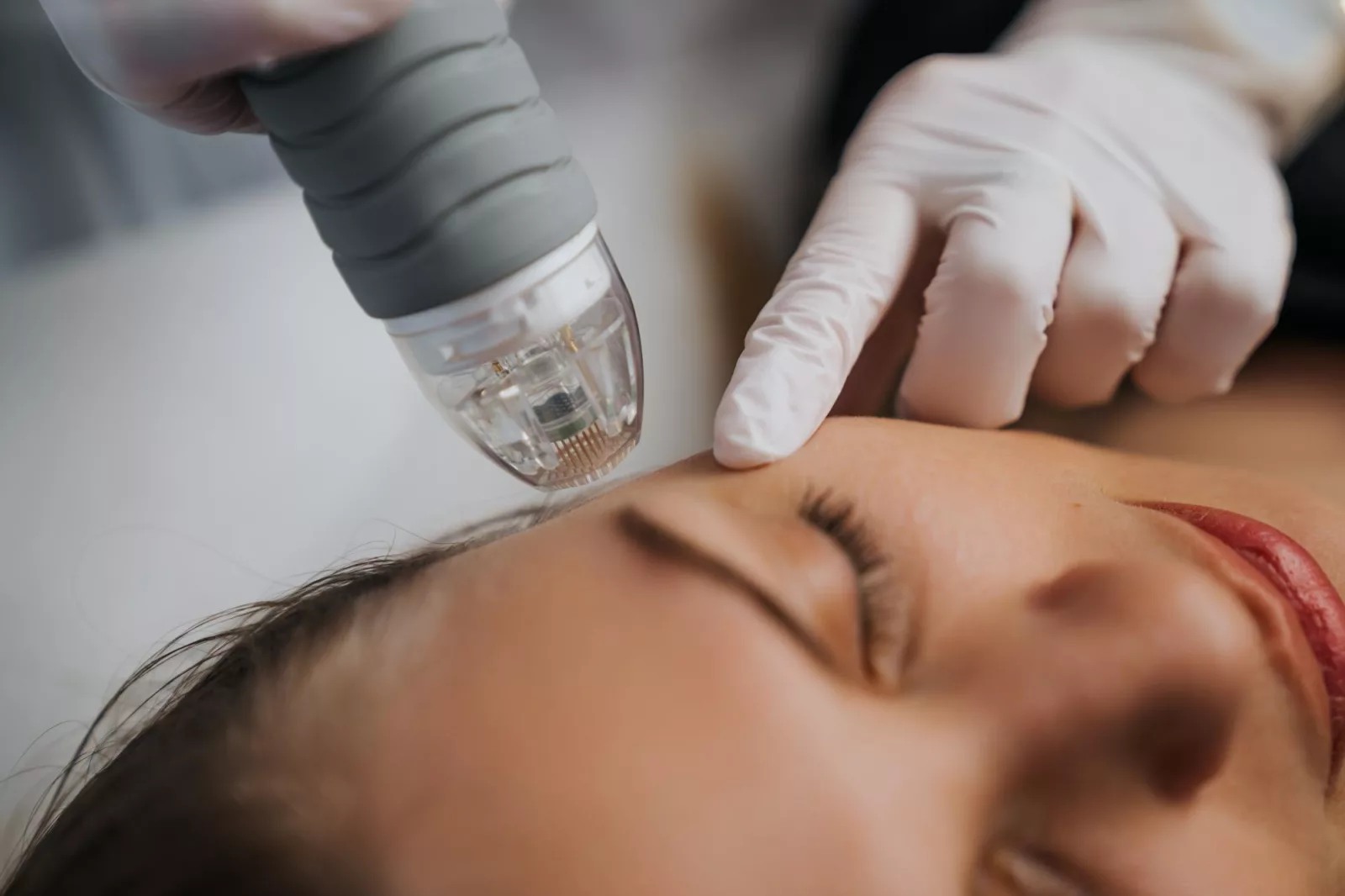Microneedling du visage : comment se déroule une séance chez nous